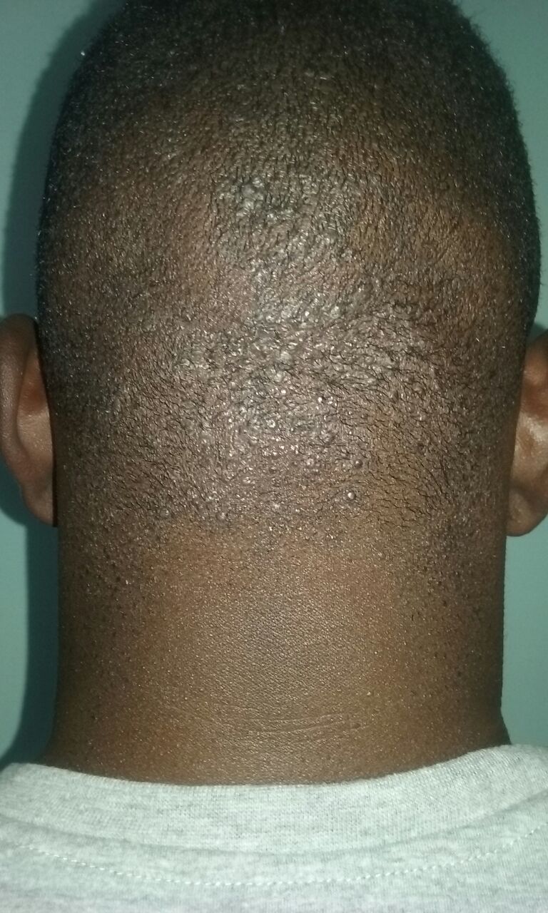 Pele depois do Tend Skin — foliculite resolvida e tom uniforme